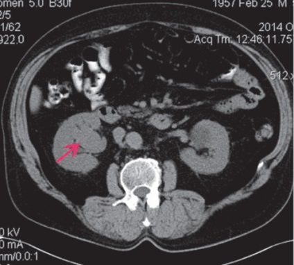 Diagnosticul de celule renale si cancer renal cu celule de tranziție - aproximativ kurzantseva