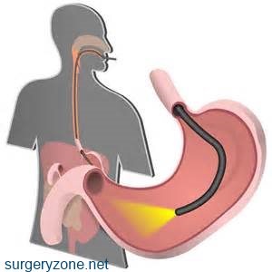 Ouă - endoscopia stomacului și a duodenului