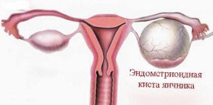 Tratamentul cu chist ovarian endometrioid și simptome, probleme și metode de infertilitate masculină și feminină