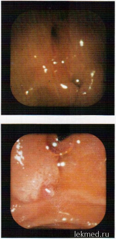 Endoscopie în diagnosticul diferențial - pancreatită cronică - un ghid clinic