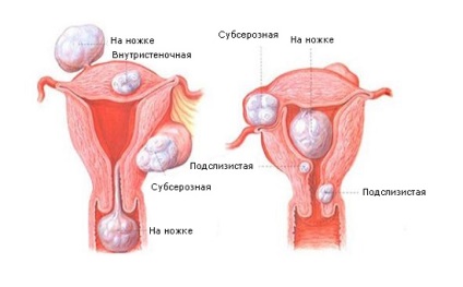 Fibromul ovarian
