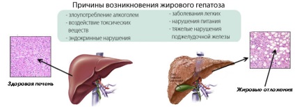 Hepatoza ficatului este ceea ce este, ceea ce este periculos