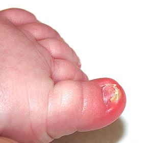 Îndoirea unghiilor la copii mici - simptome și tratament