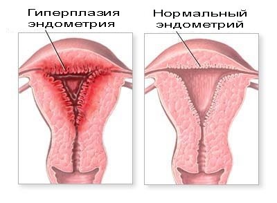 Hyperplasztikus folyamatok a méhben