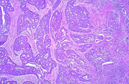 Tipuri histologice de cancer endometrial