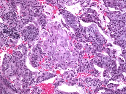 Tipuri histologice de cancer endometrial