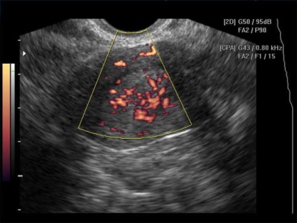 Tipuri histologice de cancer endometrial