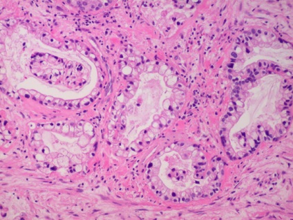 Tipuri histologice de cancer endometrial