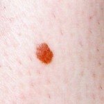 Intoxicosul nevus, sănătatea și medicina