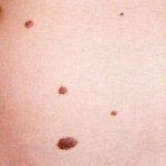 Intoxicosul nevus, sănătatea și medicina