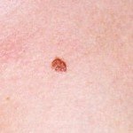 Intoxicosul nevus, sănătatea și medicina