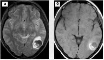 Modificări ale produselor de oxidare a sângelui asupra traumei kt și mrt - craniocerebrală la copii