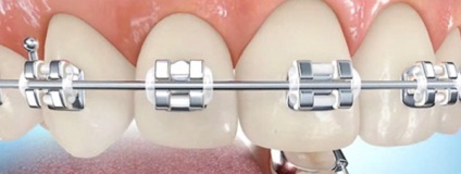 Cum de a alege sistemul de bretele drepte, branduri de sisteme de suport, ortodonție