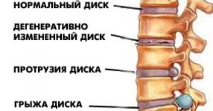 Cum să vindeci o hernie intervertebrală fără intervenție chirurgicală