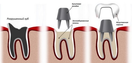 Hogyan állítsuk vissza a fogakat protézisekkel