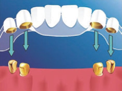 Cum să restaurați dinții cu proteze