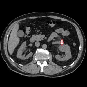 Tomografia computerizată în diagnosticul tumorilor renale, a doua opinie
