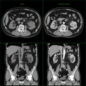 A számítógépes tomográfia a vese tumorok diagnózisában, második vélemény
