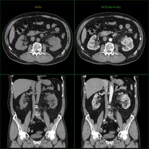 Tomografia computerizată în diagnosticul tumorilor renale, a doua opinie
