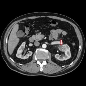 A számítógépes tomográfia a vese tumorok diagnózisában, második vélemény