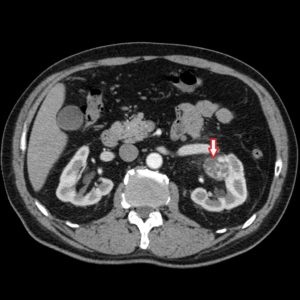 Tomografia computerizată în diagnosticul tumorilor renale, a doua opinie