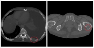 Tomografia computerizată în diagnosticul tumorilor renale, a doua opinie