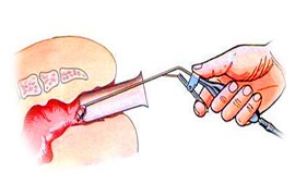 Tratamentul hemoroizilor fără intervenție chirurgicală și consecințe neplăcute