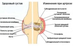 Tratamentul articulațiilor cu magneți la domiciliu și contraindicații la magnetoterapie (video)