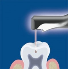 Tratamentul laser al dintilor