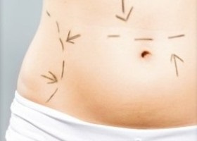 Liposucția abdomenului, coapsei, bărbie
