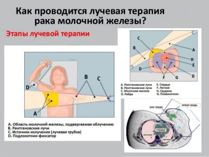 Radioterapia