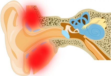 Mastoidita caracteristică, simptome, tratament, prognostic, semne