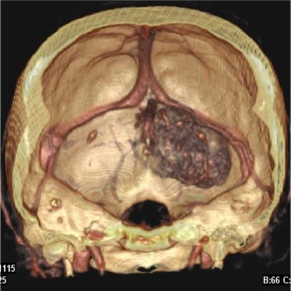 Meningiomul creierului - cauze și opțiuni pentru vindecare