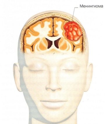 Az agy meningioma - a gyógyulás okai és lehetőségei