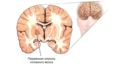 Meningiomul creierului - cauze și opțiuni pentru vindecare