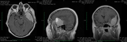 Cauze ale meningiomului cerebral, simptome, tratament și consecințe