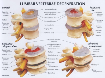 Hernia intervertebrală, centrul de corecție a coloanei vertebrale de corecție a coloanei vertebrale