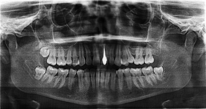 Lehetőség van arra, hogy a fogak, a fémkoronkam vagy a tüskék cochleáris implantátumát tegyék vagy csinálják