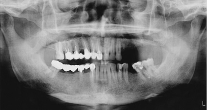 Fie că este posibil să faci sau să faci kt cu un implant cohlear de dinți, metal koronkami sau pins