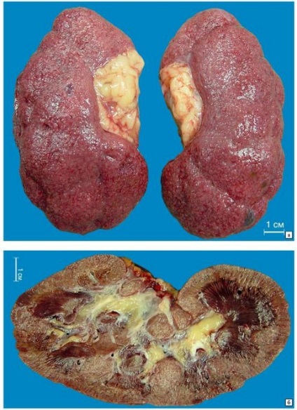 A vesék nephrosclerosisa a fejlődés fő okai és a tünetek