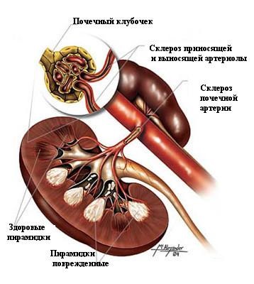 A vesék nephrosclerosisa a fejlődés fő okai és a tünetek