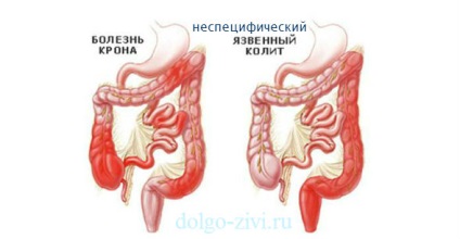 Colită ulcerativă nespecifică și boală Crohn, ce trebuie să faceți