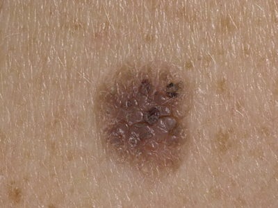 Nevus (nepigmentat, intradermic, neovocolat) soiuri, tratament