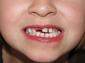 Caracteristicile dinților copilului care dispar și schema schimbării lor este constantă, ce să atragă