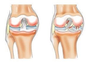 Osteoartrită a tratamentului articulației genunchiului cu remedii folclorice, tratament cu remedii folclorice