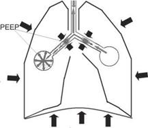 Peep, cpap și linia de bază ceea ce este peep (presiune expiratorie sfârșitul pozitiv), și pentru ce este