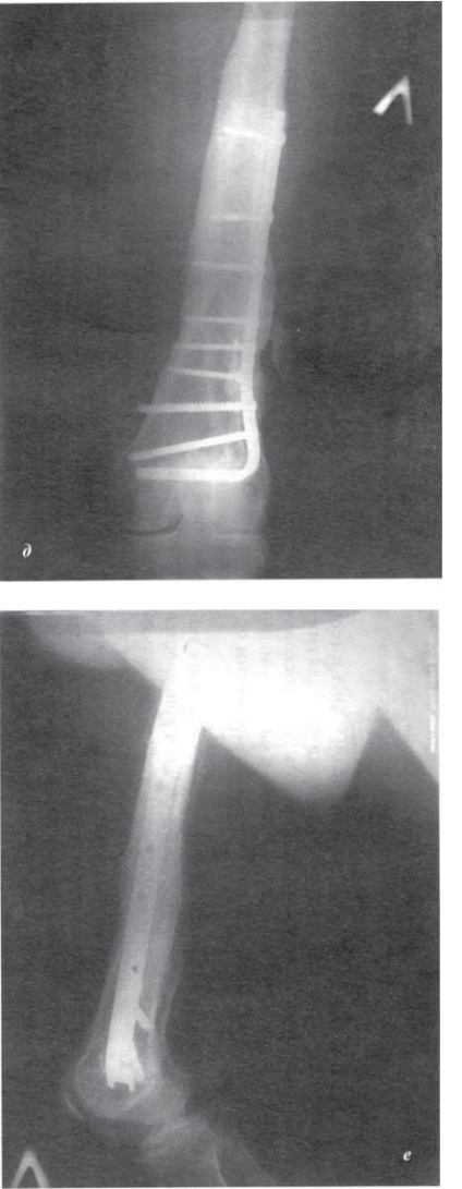 Fracturile capătului distal al coapsei - politrauma, fracturile intra și periarticulare - intervenții chirurgicale și