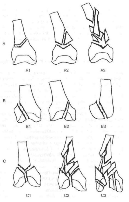 Fracturile capătului distal al coapsei - politrauma, fracturile intra și periarticulare - intervenții chirurgicale și
