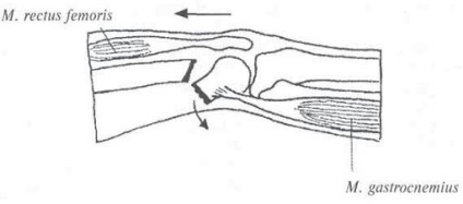Fracturile capătului distal al coapsei - politrauma, fracturile intra și periarticulare - intervenții chirurgicale și