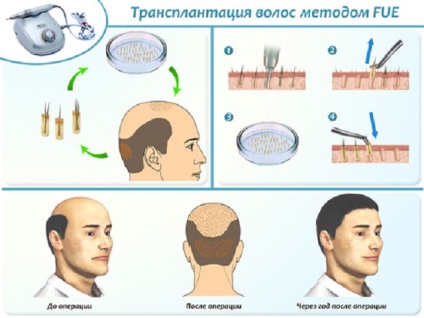 Transplantul de păr - funcționarea și metodele de transplant